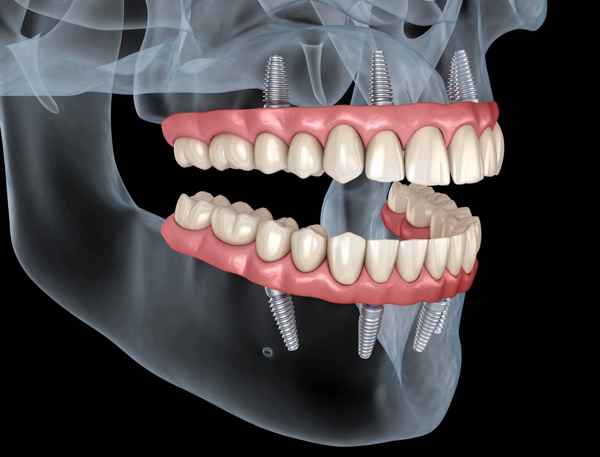 Excessive-gums-needs-dentist-waxhaw-nc Excessive gums needs dentist waxhaw nc