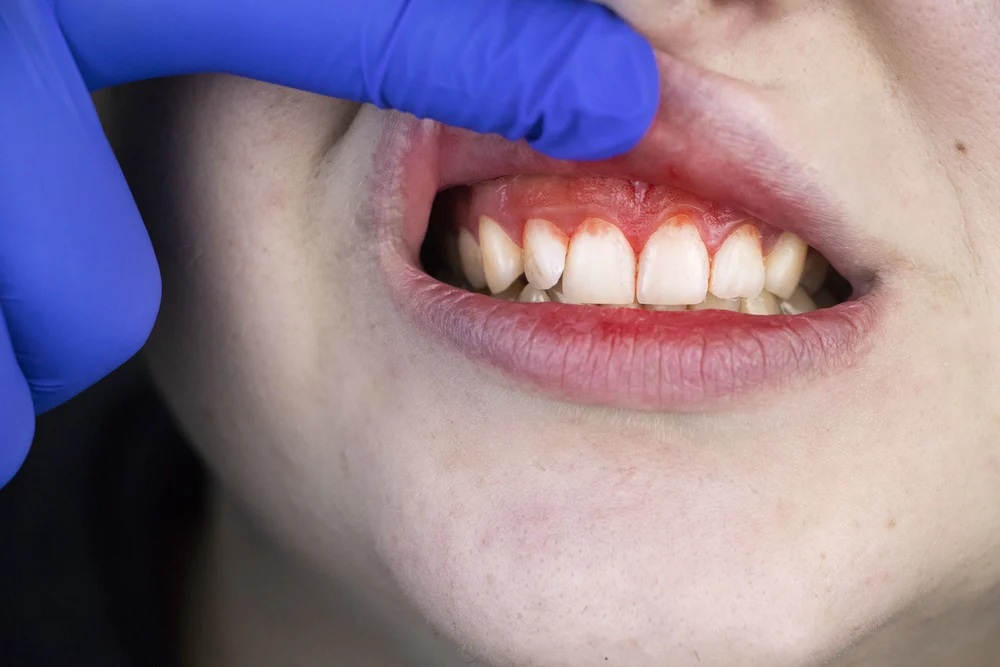 Gummy smile needs Excessive gums needs dentist waxhaw nc