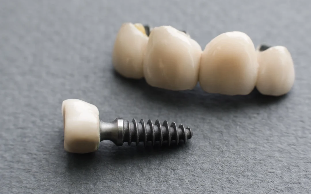 Modern Dental Implant Technology Available Used by Dentists Today