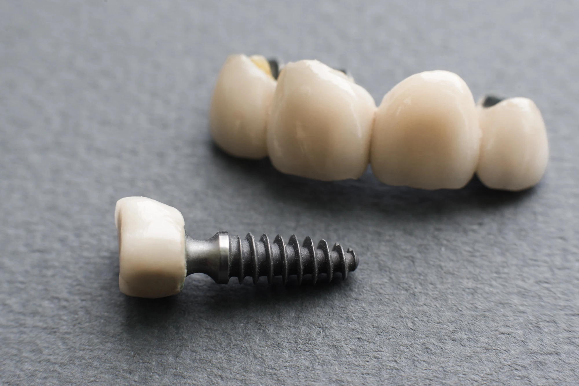 actual-tooth-for-dental-implant-procedure actual tooth for dental implant procedure