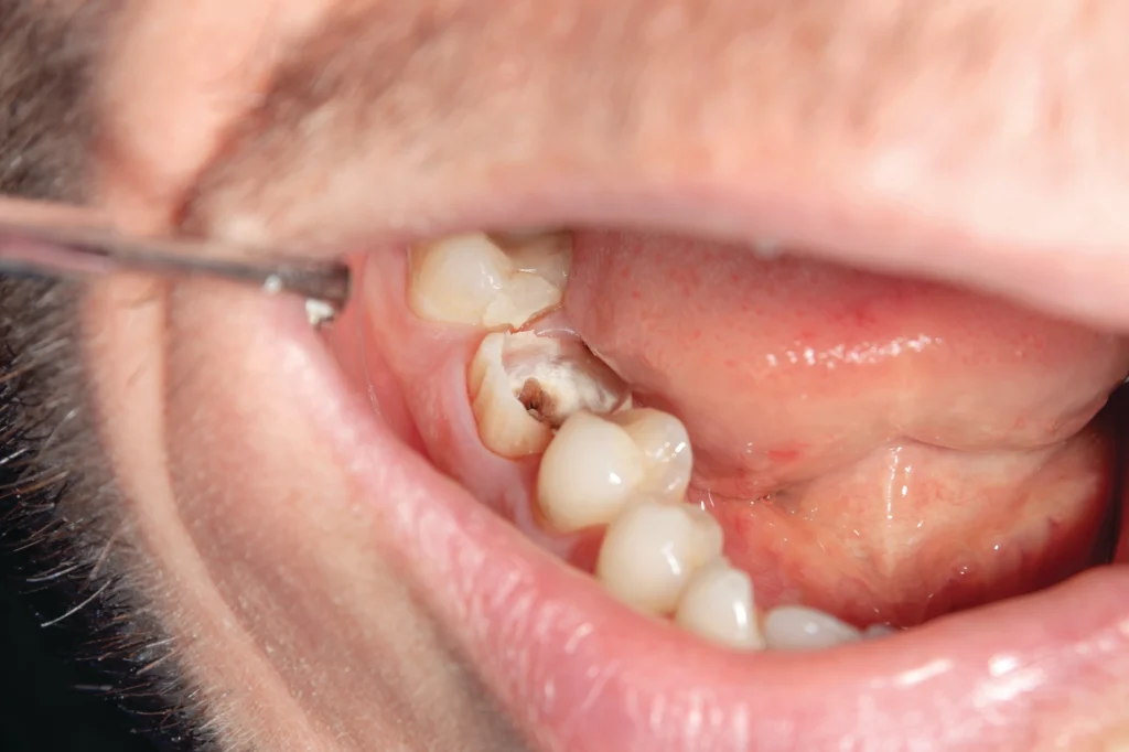 dental case when a root canal treatment is needed