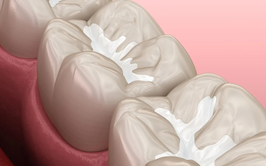 How The Best Dentist Addresses Dental Sealant Needs