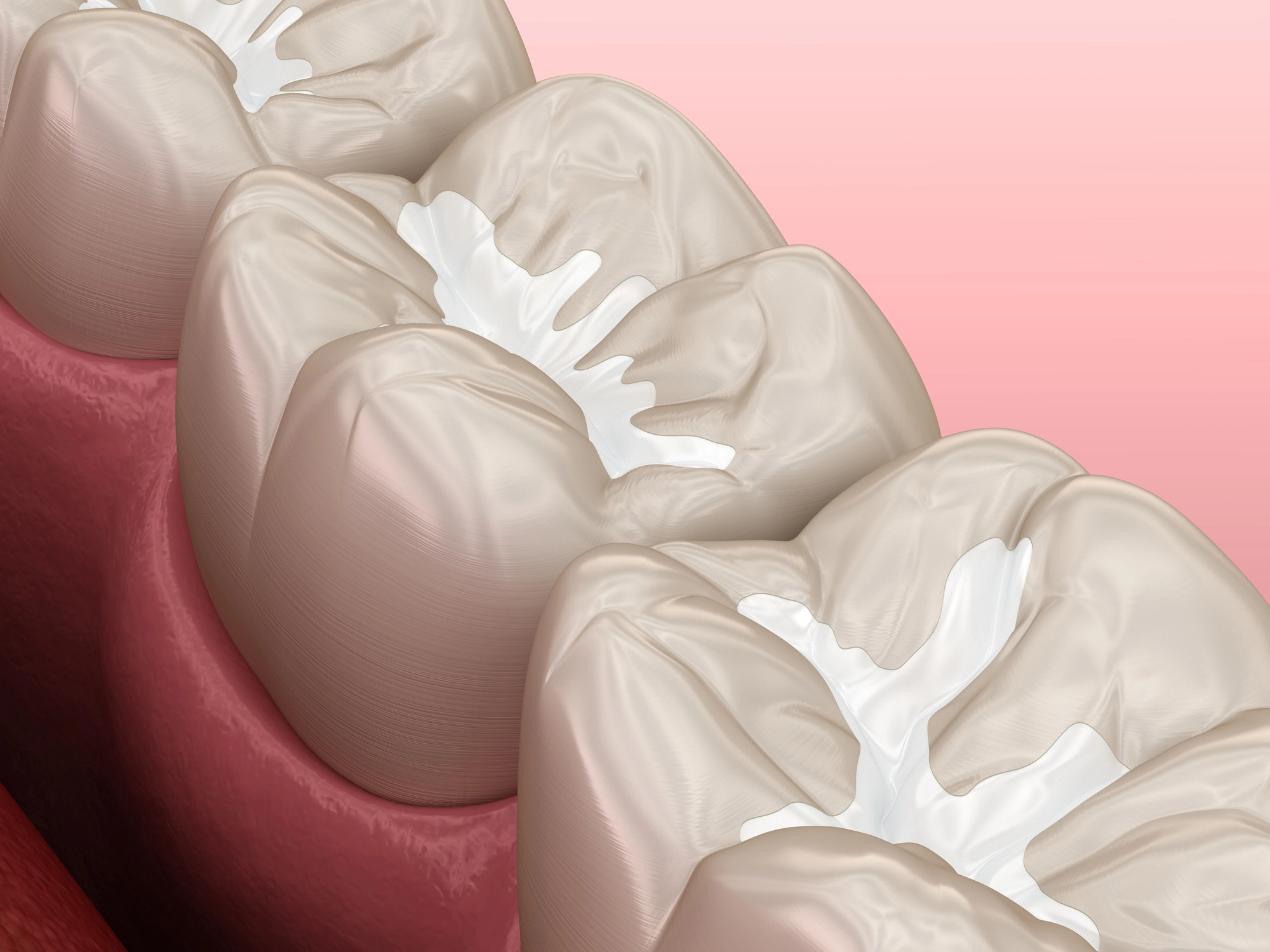 header-photo-of-dental-sealant-procedure-by-the-best-dentist-in-Waxhaw-NC header photo of dental sealant procedure by the best dentist in Waxhaw, NC