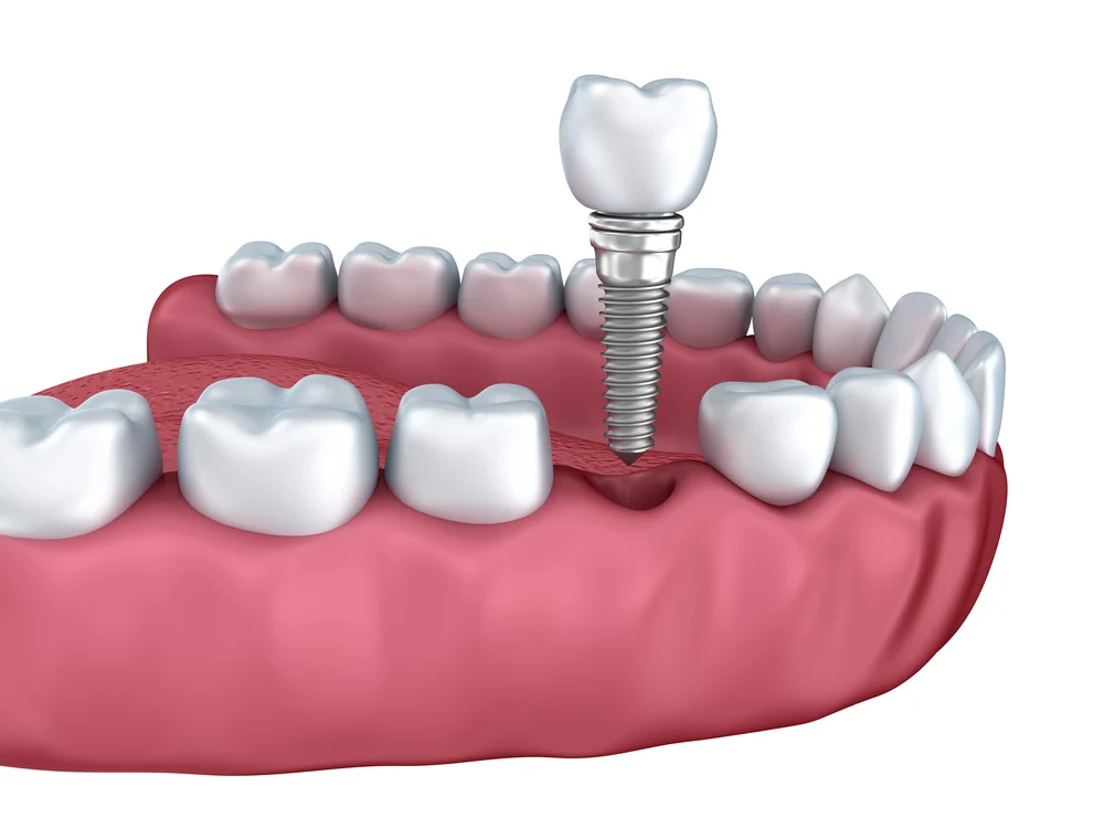 header shot of how dental implants are done