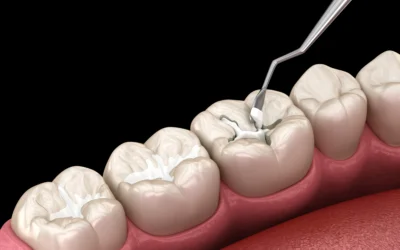 How A Waxhaw Dentist Addresses The Need For Dental Sealants