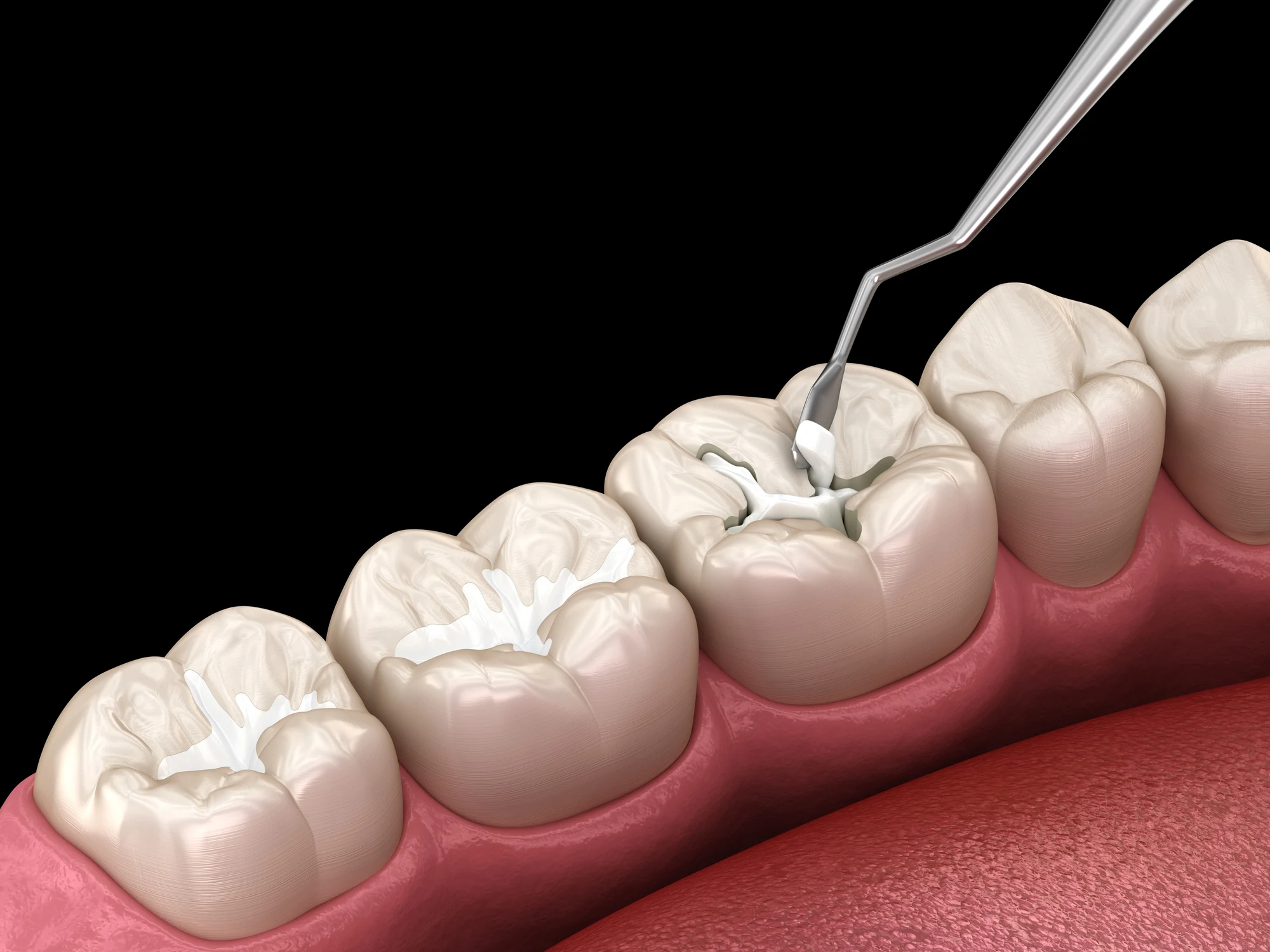 need a dental sealant by a Waxhaw Dentist