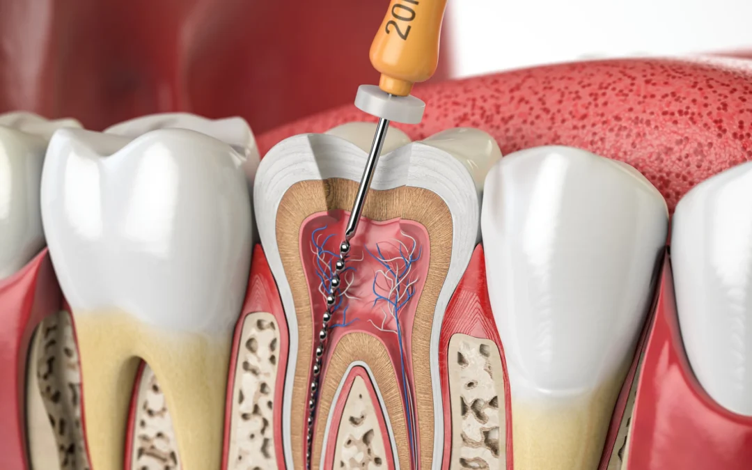 What Should You Avoid After Root Canal Treatment?