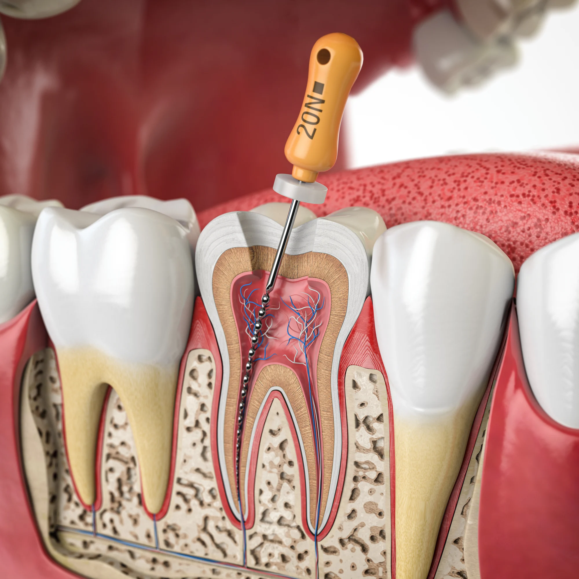 root canal procedure illustration