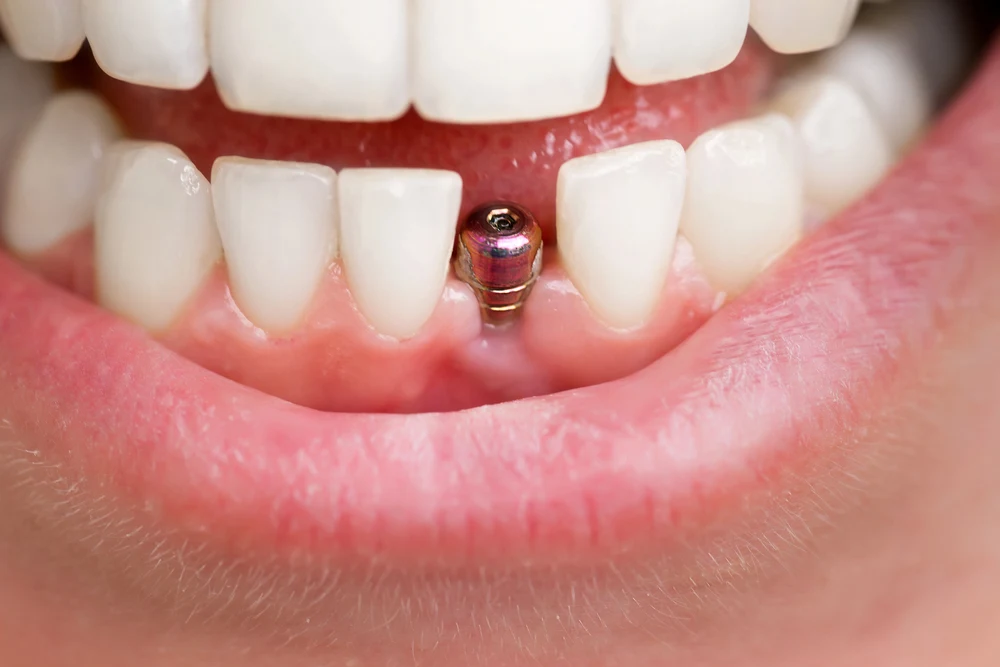 site preparation for dental implant procedure