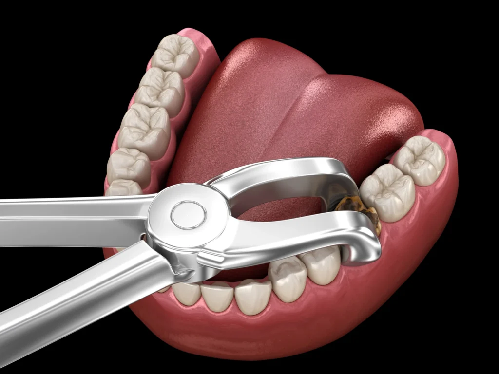 tooth extraction illustration