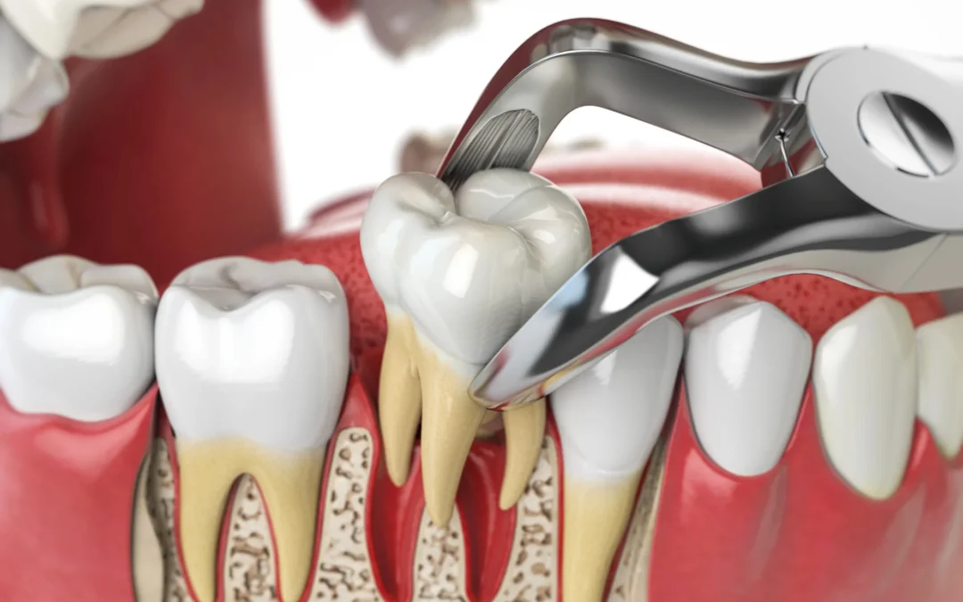 Is Tooth Extraction the Only Option for a Damaged Tooth? 