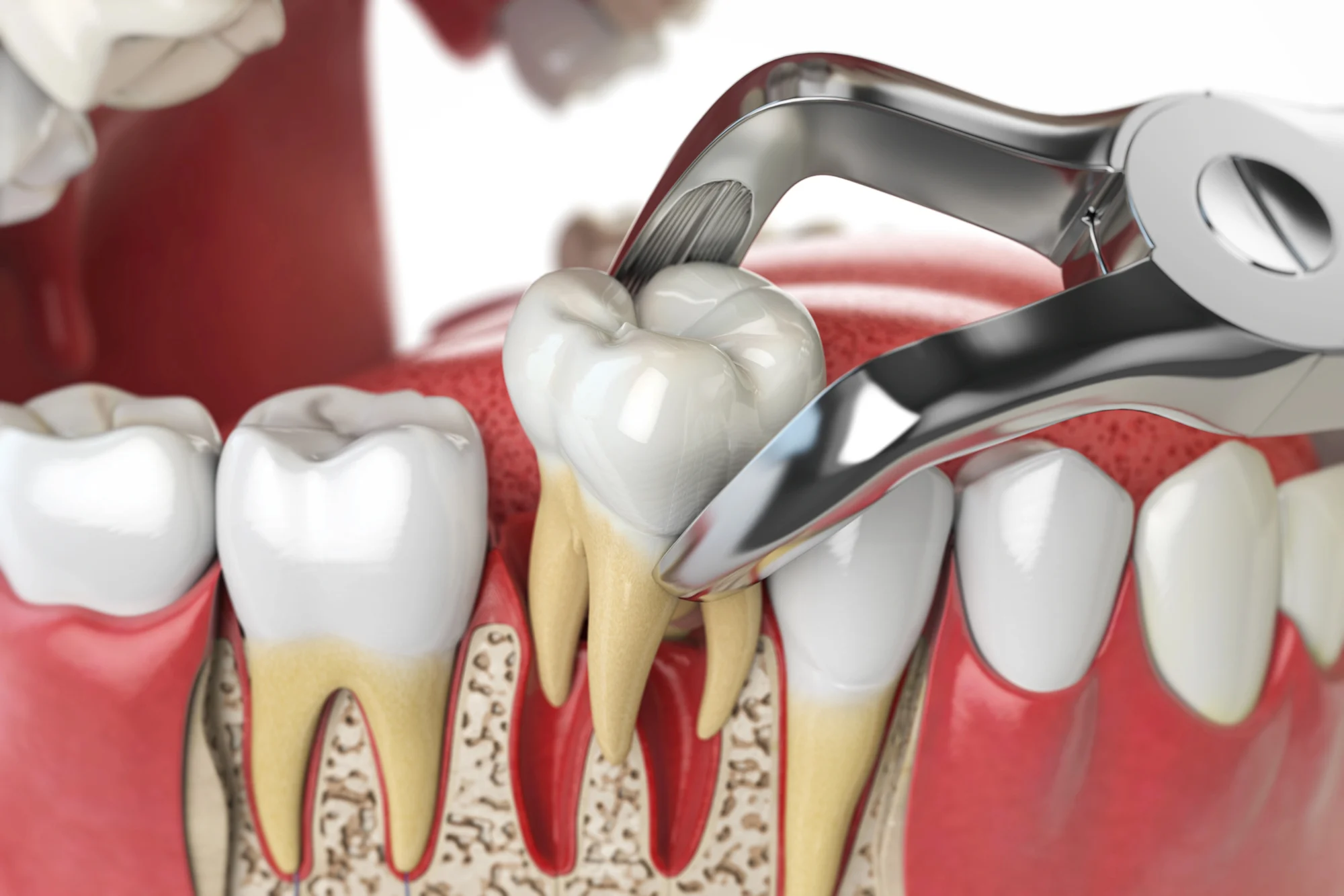 tooth extraction procedure illustration