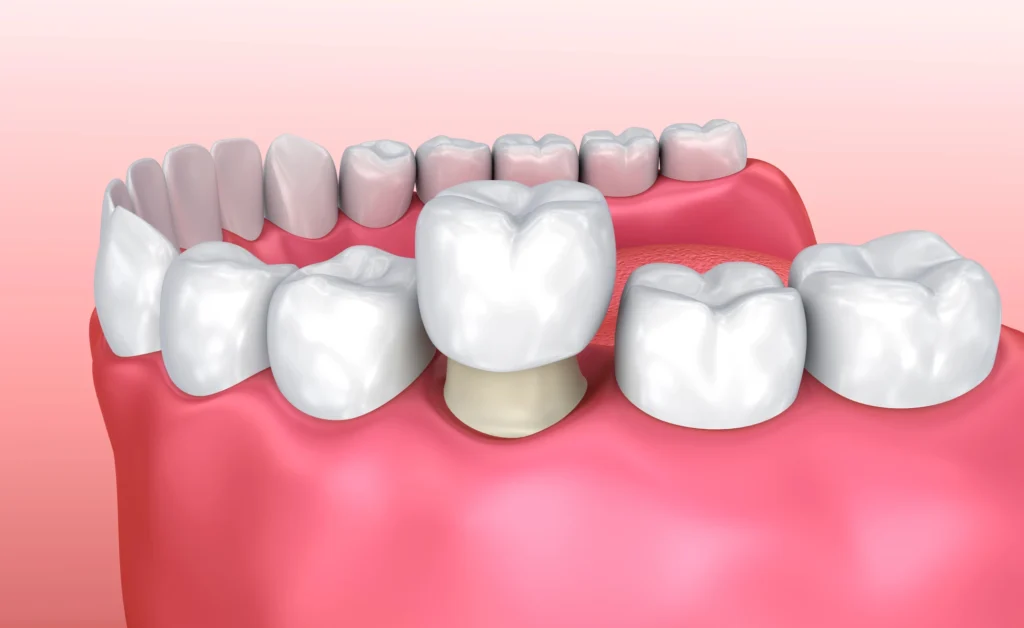 waxhaw-dental-crown-3d-model-tooth-restoration