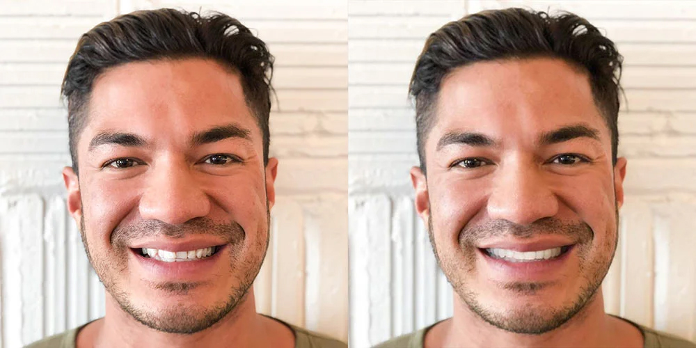 Invisalign SmileView before and after preview