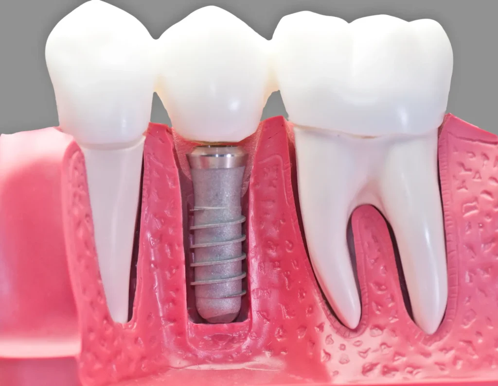 Capped implant model illustrating dental implants in Waxhaw