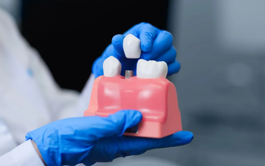 5 Common Myths About Dental Implants, Debunked 