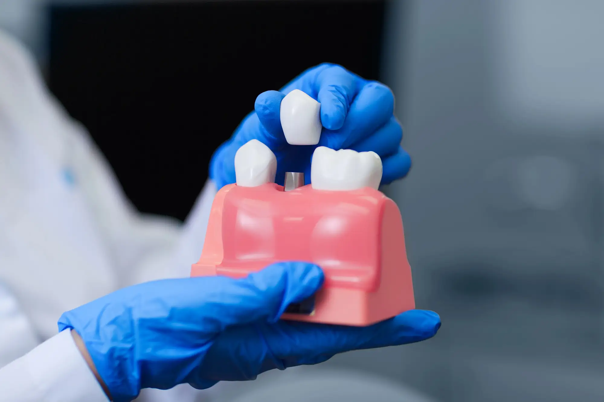 Doctor-holding-a-dental-implant-model-for-dental-implants-in-Waxhaw Doctor holding a dental implant model for dental implants in Waxhaw